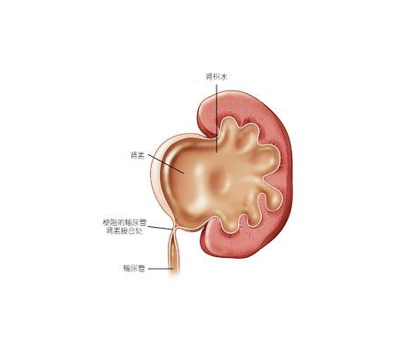 肾积水疾病