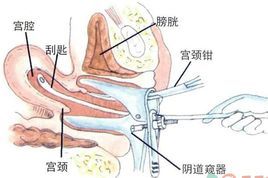 刮宫(疾病)刮宫是指刮取子宫内膜或宫腔内容物的手术.