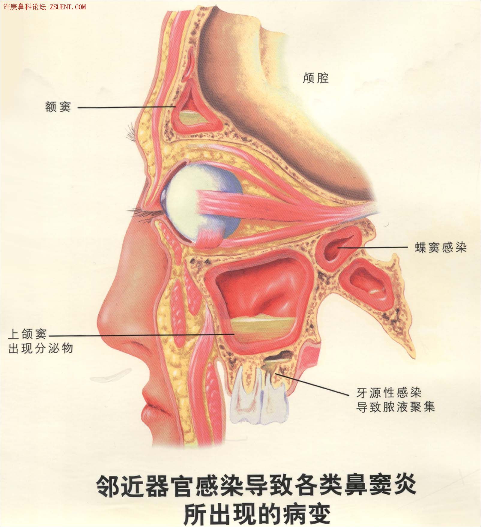 蝶窦炎医学名词