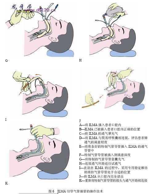 气管插管