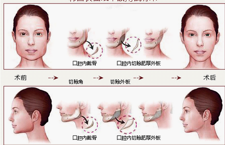 下颌骨整形术(临床医学)下颌骨部分主要包括下颏,下颌缘和下颌角三