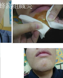 蜂窝组织炎症严重吗 t01dc1a376639e769d4.png