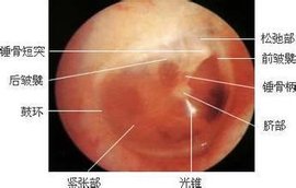 鼓膜内陷  免费编辑   添加义项名