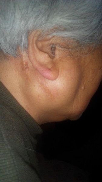 腮腺混合瘤症状图片