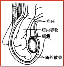 腹股沟直疝修复术(临床医学)