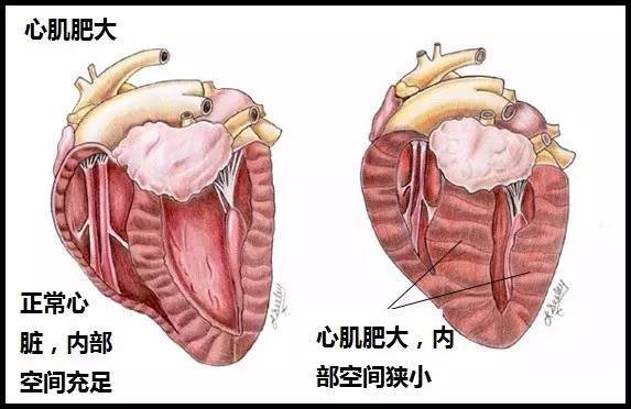 心臟肥大基礎醫學科學名詞