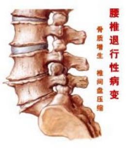 腰椎退行性变 (医院)