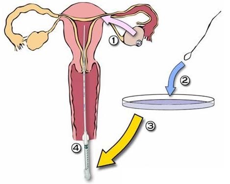人工授精技术(医院)