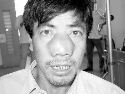 蛙鼻(疾病)
