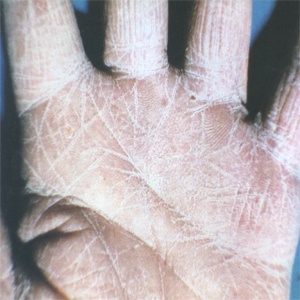 角化增厚型手癣 (疾病)