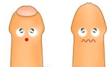 包皮过长是指男子成年后,阴茎皮肤包裹龟头,使龟头不能完全外露.