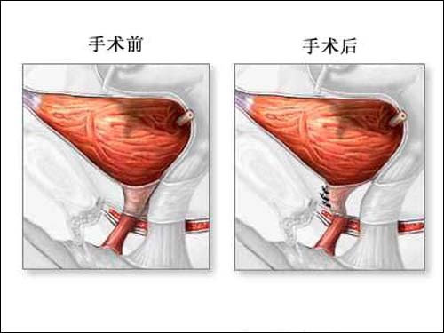 阴道前壁脱垂(疾病)阴道前壁脱垂常伴有膀胱膨出和尿道膨出,以膀胱