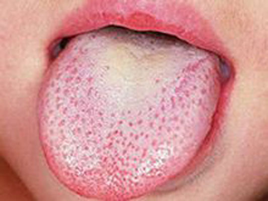 梅毒病人的舌头图片图片