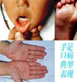 手口足病 (疾病)