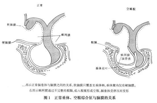 空泡蝶鞍综合症(医学名词)