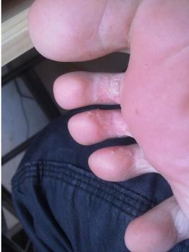 脚汗症(疾病)_技点科普_技点网(疾病)