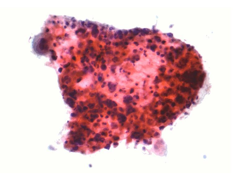 低的部分肺鳞癌,相对于癌细胞分化程度较高的部分肺鳞癌而言,鳞状细胞