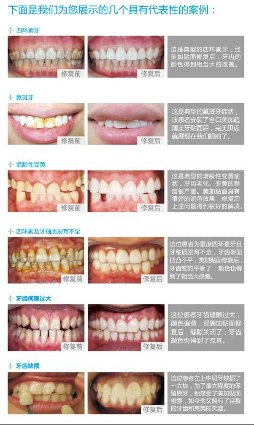 釉质发育不全图片图片