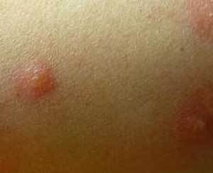 乙酰胆碱性荨麻疹图片图片