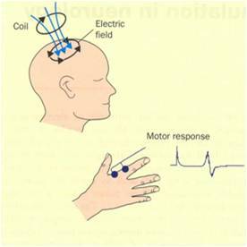 运动诱发电位疾病