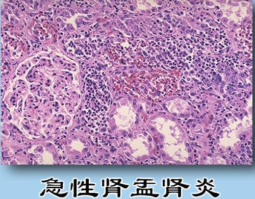 急性肾盂肾炎症状疾病