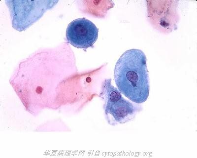 肠上皮化生