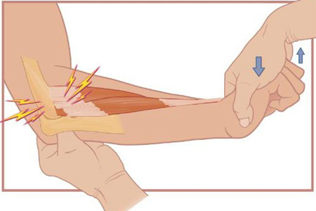 反手網球肘疾病