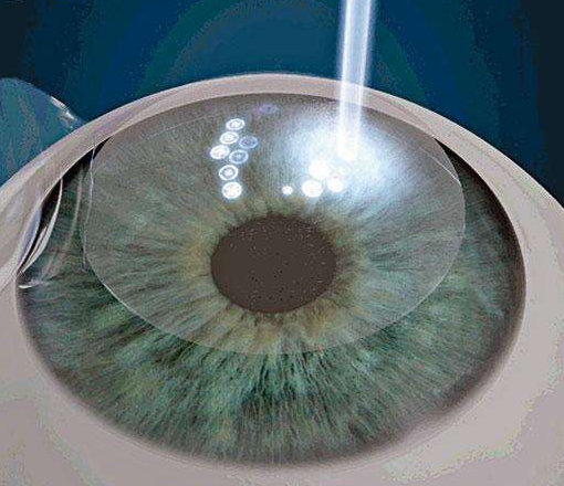 激光矫视(其他计算机科学技术相关)激光矫视指以激光永久改变眼角膜的