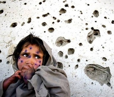 病是由利什曼原虫引起的人畜共患病,可引起人类皮肤及内脏黑热病