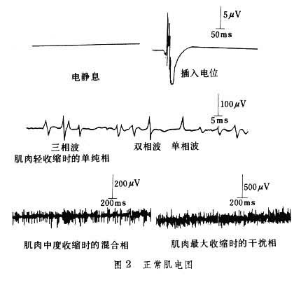 面神经肌电图图解图片