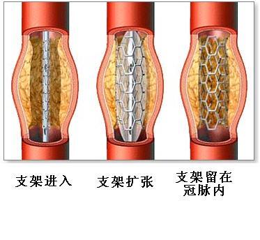 心脏搭桥