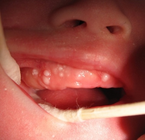 儿童牙龈上长白色硬物图片