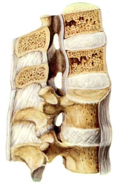颈椎退行性变 (疾病)