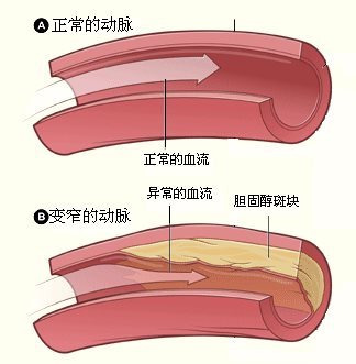 痉挛是指各种原因所致的冠状动脉一过性收缩,引起血管不完全性或完全