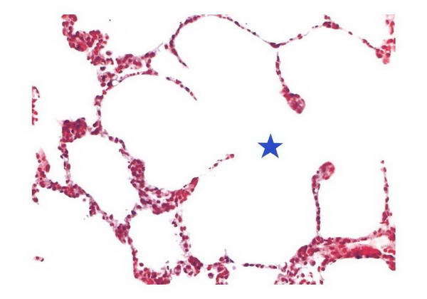 肺泡囊其他生物相关