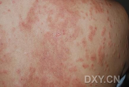 湿疹是一种常见的由多种内外因素引起的表皮及真皮浅层的炎症性皮肤病