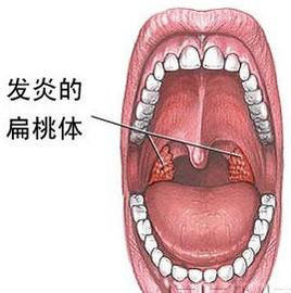 扁桃體疾病