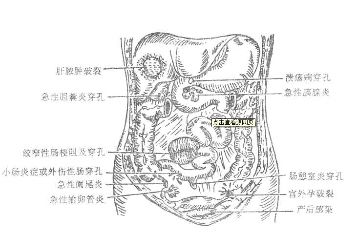 腹膜刺激征(疾病)腹部压痛,反跳痛和腹肌紧张是腹膜炎常出现的主要