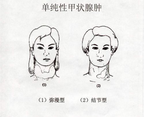 单纯甲状腺肿(症状)