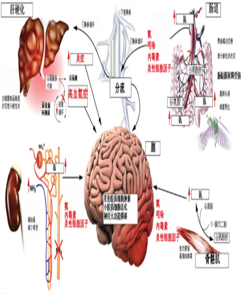 肝性脑病的发病机制图片