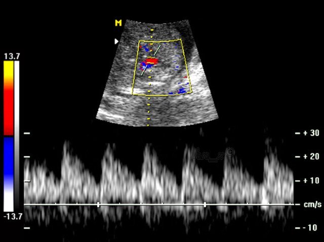 脐动脉血流s/d值(疾病)